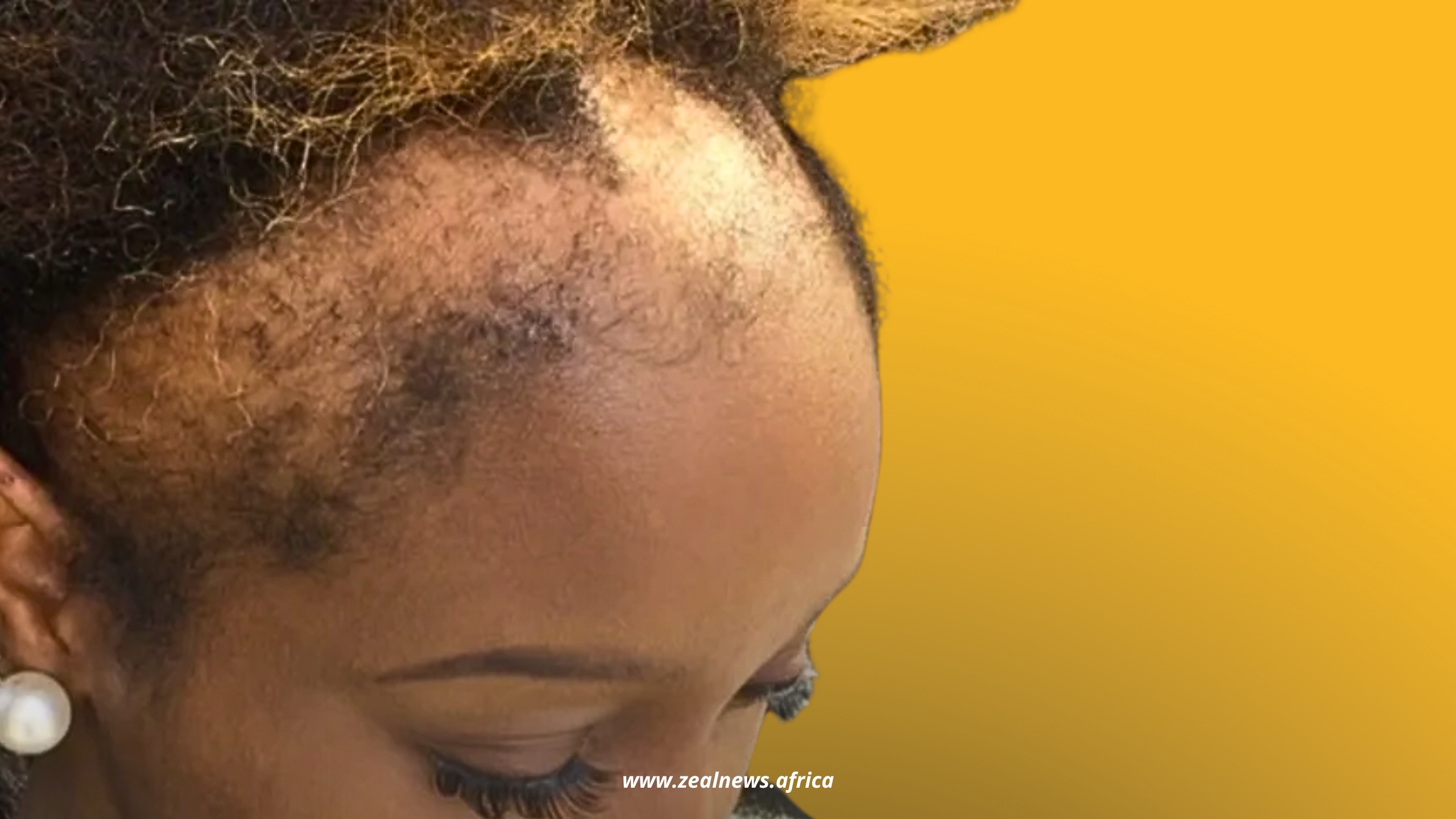 Frontals Are Giving Young Women Traction Alopecia, And Many Don't Know It