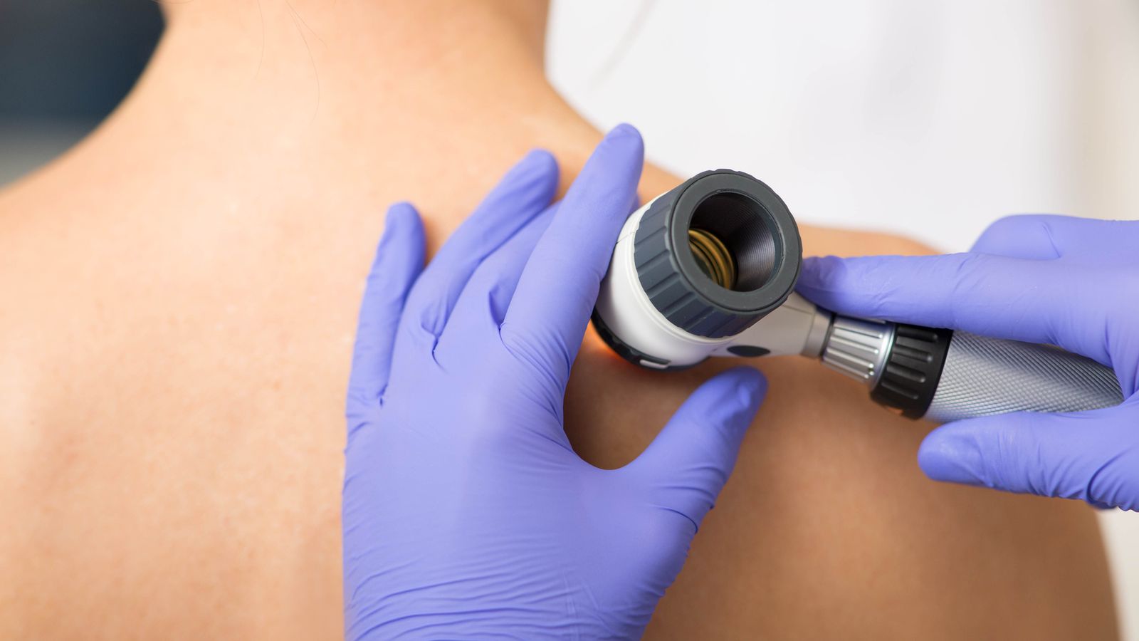 Alarming Health Crisis: UK Melanoma Cases Soar to Record High