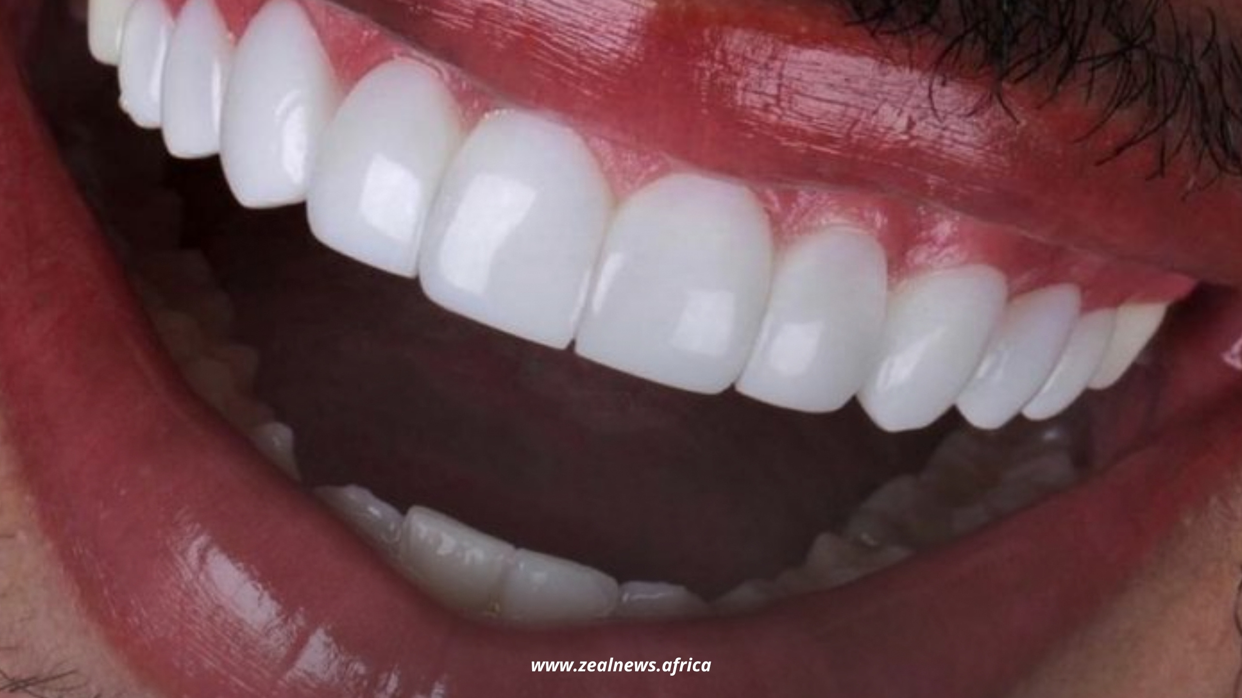 Veneers Look Good Online, But What Do They Actually Do to Your Teeth?